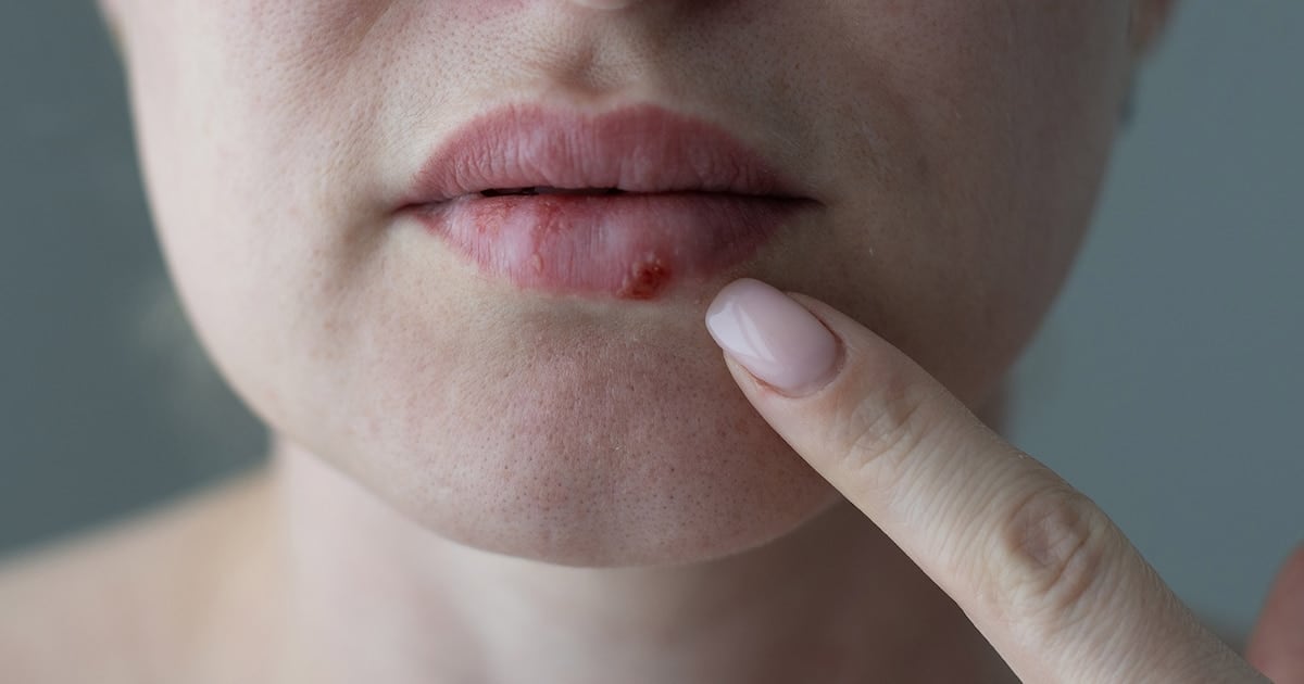 La FDA aprueba un antiviral oral inédito en casi 30 años para herpes resistente en pacientes inmunocomprometidos