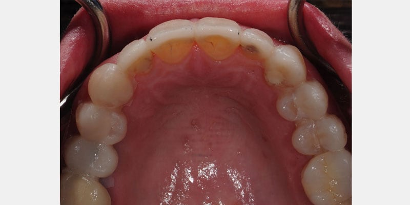 Carillas dentales: los sinais de alerta para actuar antes de perder el sellado